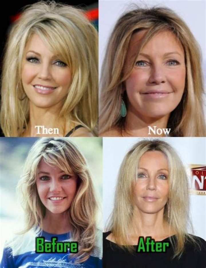 Heather Locklear Face Lift and Plastic Surgery – Weight Gain Explained